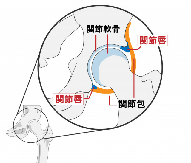 変形性股関節症