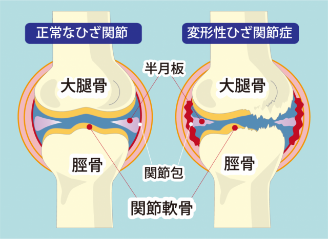 膝関節痛